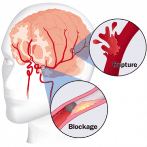 Transplanted neurons can help post stroke damaged brains Age In Place Home Care 0