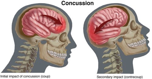 Research indicates a link between concussions and Alzheimer’s disease Age In Place Home Care 231